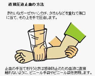 直接圧迫止血の方法　きれいなガーゼやハンカチタオルなどを重ねて傷口に当てその上を手で圧迫します